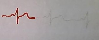 Document. Electrocardiogramme d'un adolescent de 15ans.